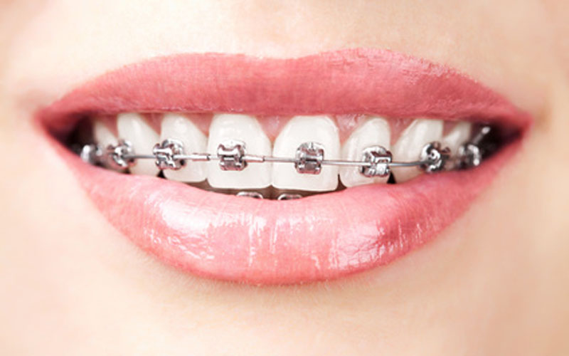 teeth with braces | marpole orthodontics